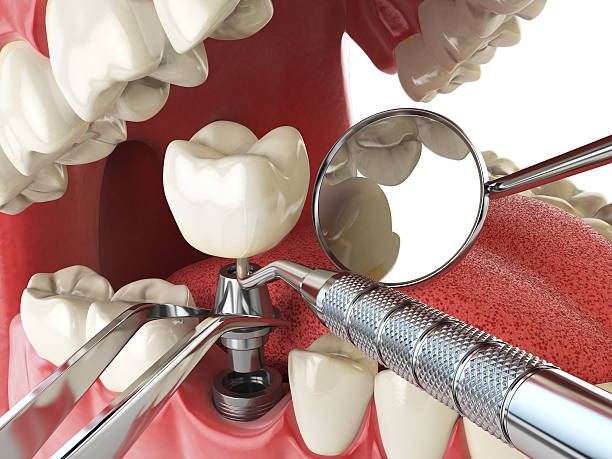 Best Emergency Root Canal Therapy in Clendenin, WV